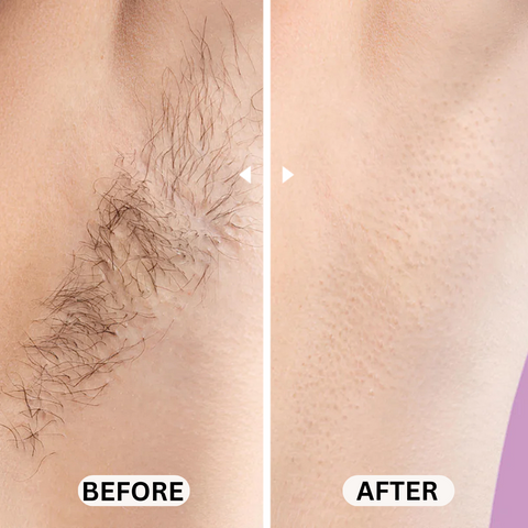✨ IPL Laser Hair Removal Device – Permanent, Painless, At-Home Hair Removal for Women & Men | 5 Adjustable Energy Levels | 500,000 Flashes | Face, Legs, Bikini & Body