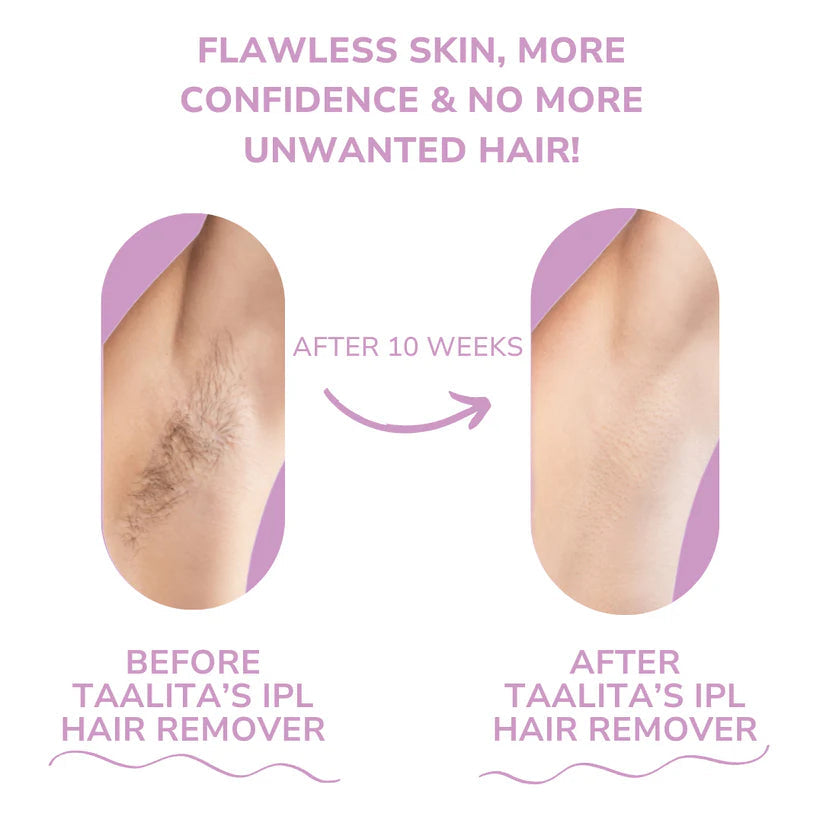 ✨ IPL Laser Hair Removal Device – Permanent, Painless, At-Home Hair Removal for Women & Men | 5 Adjustable Energy Levels | 500,000 Flashes | Face, Legs, Bikini & Body